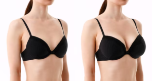 Miami's Breast Implants Services: What to Expect