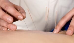 Dry Needling and Its Therapeutic Advantages